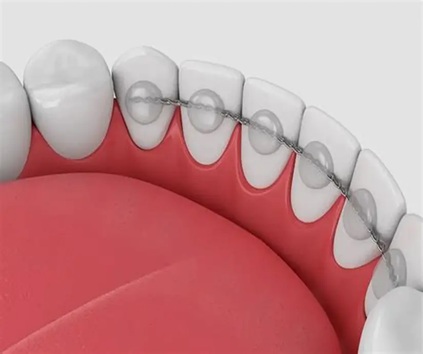  Dental Bonding 